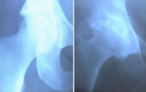 Пена артроза коленного сустава